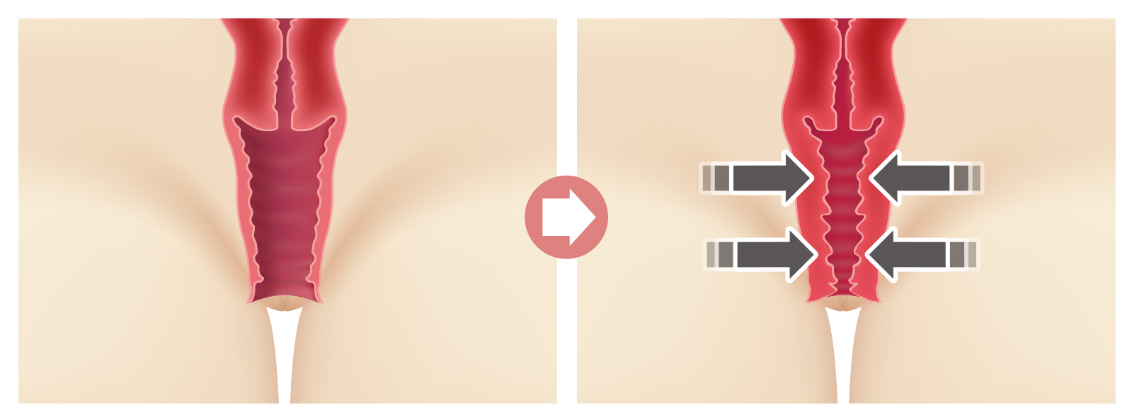 韓式陰道緊縮手術，是以類似用線圈一圈圈的套緊，由大變小由鬆至緊
